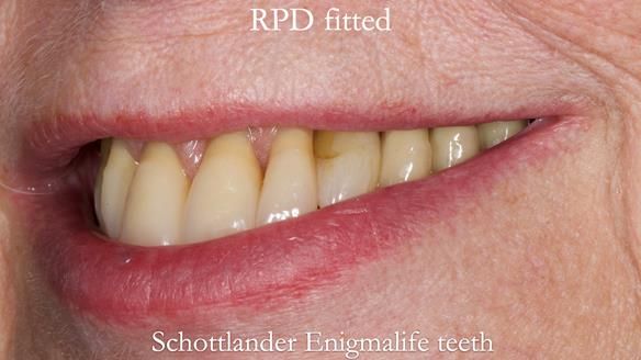 Finlay's Newsletter 59 Ultra hard partial dentures made for Gill