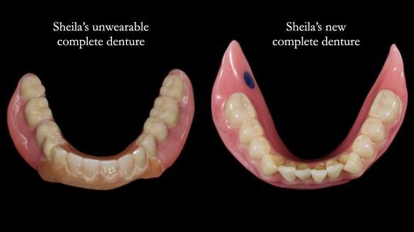 Newsletter 83: Sheila’s Complete Denture Success