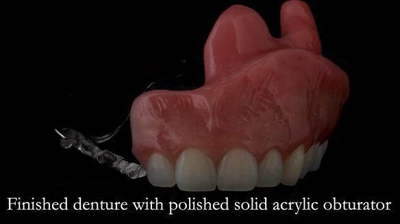 Upper metal base partial denture/occlusal stabilisation splint/obturator - full protocol