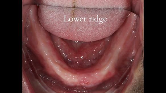 Finlay's Newsletter 62 provision of extractions and metal based complete dentures for Rafique