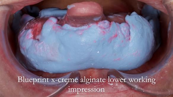 Newsletter 52 Managing Jo’s failing dentition with extractions and Mk 1/Mk 2 complete upper dentures and lower partial dentures FULL PROTOCOL