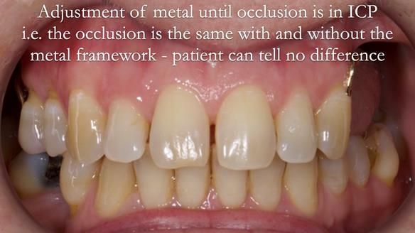 Solving Sue's failed implants with metal based RPD - full protocol Newsletter 43