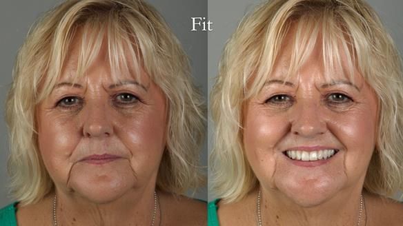 Newsletter 68 Restoring Jan’s Smile: Complete Dentures Inspired by Her Daughter’s Teeth - Post Mouth Surgery