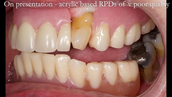 Finlay's Newsletter 59 Ultra hard partial dentures made for Gill