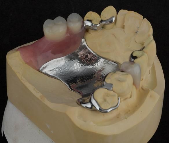 Figure 77 Finished definitive partial denture. Scandinavian design - keeping the denture components 3mm away from the gingival margin