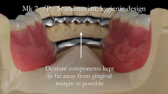 Newsletter 52 Managing Jo’s failing dentition with extractions and Mk 1/Mk 2 complete upper dentures and lower partial dentures FULL PROTOCOL