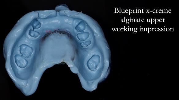 Newsletter 81 - Pam’s Story — how a partial denture changed her life (+ live walkthrough this Thursday)