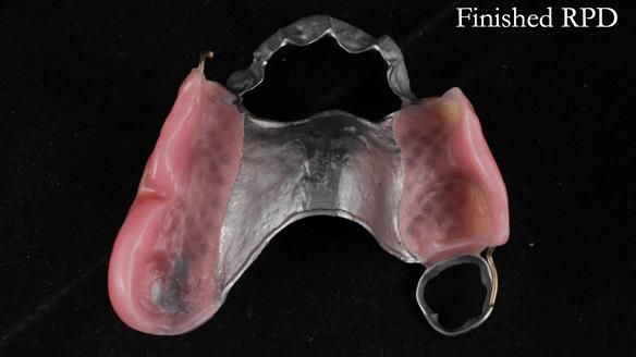 Finlay's Newsletter 60 Sylvia's upper Kennedy Class 2 Mod 1 metal based upper RPD