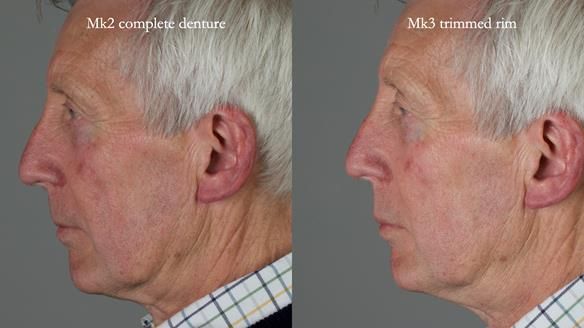 Newsletter 77: Jeremy’s case – immediate complete upper denture