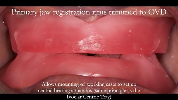 Newsletter 53 showing the making and fitting of ultra life-like dentures for Valena