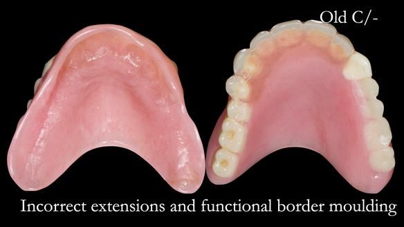 Newsletter 54 case presentation upper complete denture and lower Scandinavian designed hygienic partial denture for David