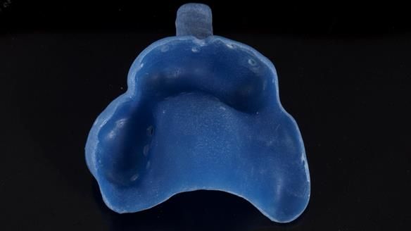 Newsletter 86 Peter the Architect — precision removable partial dentures case study