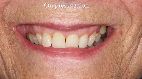 Finlay's Newsletter 61 provision of a lower unilateral free end saddle metal based partial denture for Joyce