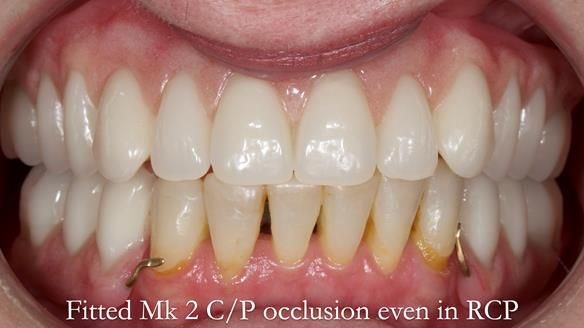 Newsletter 52 Managing Jo’s failing dentition with extractions and Mk 1/Mk 2 complete upper dentures and lower partial dentures FULL PROTOCOL