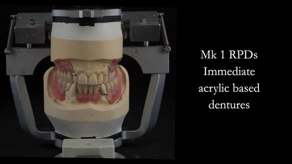 Finlay's Case Study Newsletter 40 - Immediate Mk 1 RPD to Definitive Mk 2 RPD - full protocol