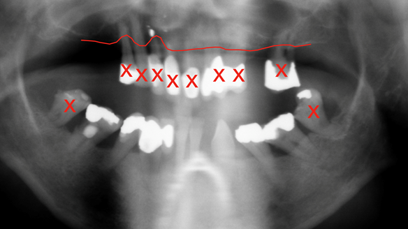 Figure 7 OPG radiograph supplied by the referring GDP showing reduced bone levels and planned extractions