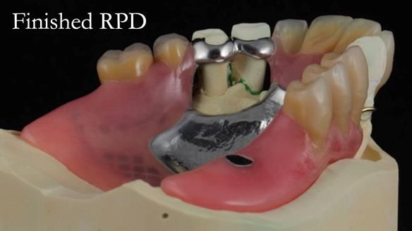 Finlay's Newsletter 59 Ultra hard partial dentures made for Gill