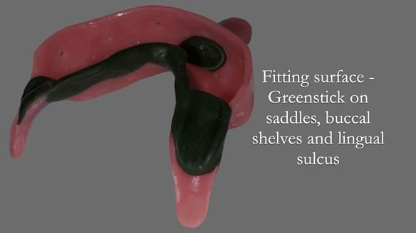 Newsletter 52 Managing Jo’s failing dentition with extractions and Mk 1/Mk 2 complete upper dentures and lower partial dentures FULL PROTOCOL