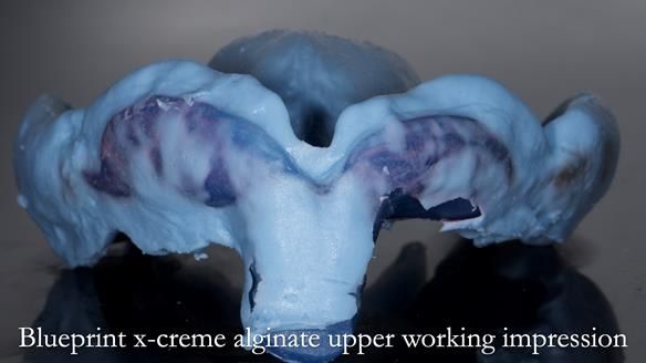 Newsletter 77: Jeremy’s case – immediate complete upper denture