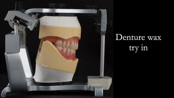 Newsletter 75: Marion’s case - Step-by-step complete denture workflow