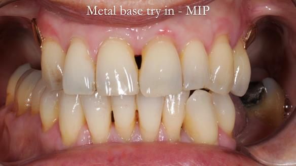 Newsletter 56 showing the making and fitting of a bilateral free end saddle upper removable partial denture (RPD) for patient with pemphigus