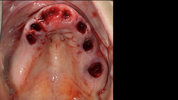 Figure 33 Upper teeth removed