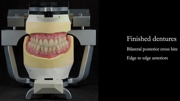 Finished dentures