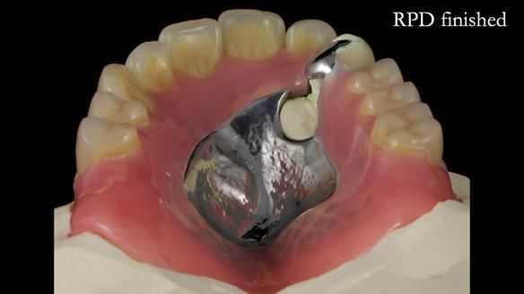 Newsletter 55 Provision of metal based partial dentures for Zephyrine with a repaired cleft lip and palate