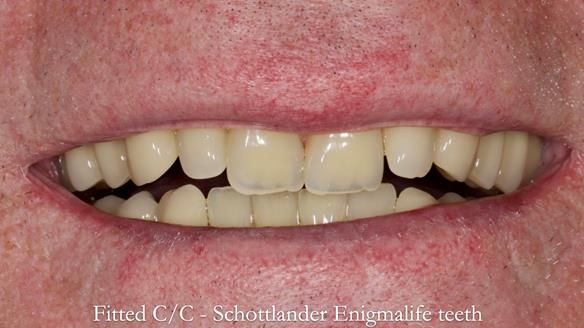 Complete denture Class II div 2 deep overbite Newsletter 39