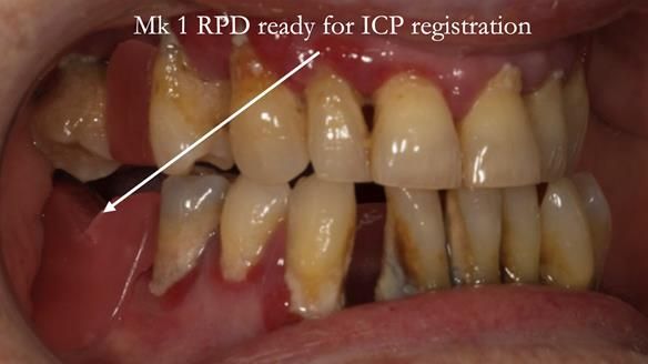 Finlay's Case Study Newsletter 40 - Immediate Mk 1 RPD to Definitive Mk 2 RPD - full protocol