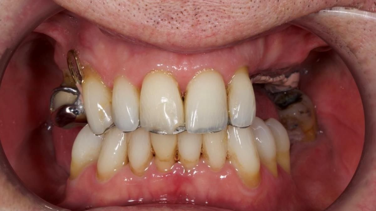 Newsletter 89 – Simon: A Challenging Kennedy Class II Division 1 Upper CoCr Partial Denture with a High Smile Line