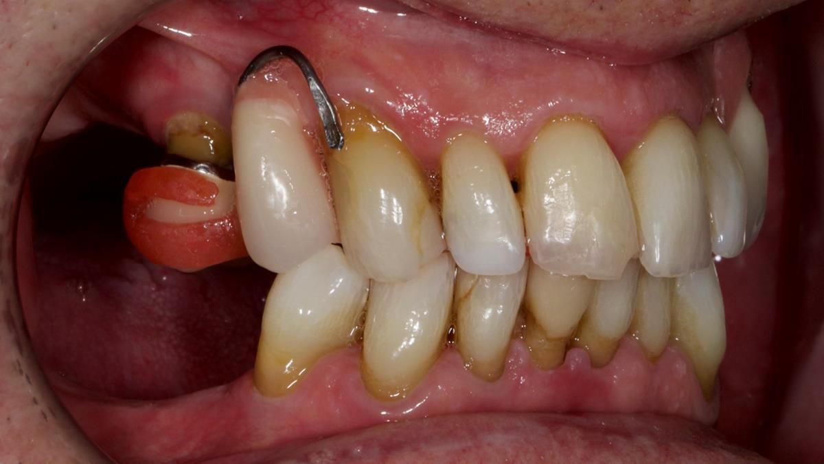 Newsletter 89 – Simon: A Challenging Kennedy Class II Division 1 Upper CoCr Partial Denture with a High Smile Line