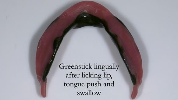 Replacing Madeline’s Complete denture FULL PROTOCOL