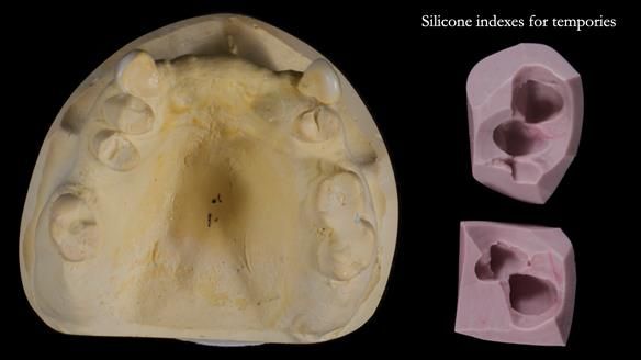Newsletter 81 - Pam’s Story — how a partial denture changed her life (+ live walkthrough this Thursday)