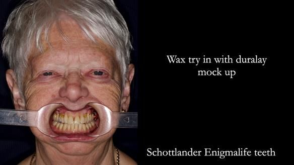 Finlay's Newsletter 59 Ultra hard partial dentures made for Gill