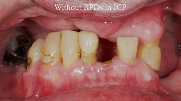 Newsletter 55 Provision of metal based partial dentures for Zephyrine with a repaired cleft lip and palate