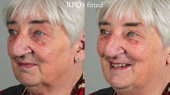 Newsletter 55 Provision of metal based partial dentures for Zephyrine with a repaired cleft lip and palate