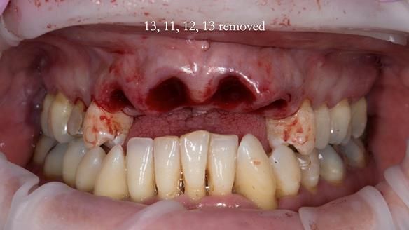 Finlay's Newsletter 63 Case study provision of metal based Scandinavian RPD - functional 10 years on