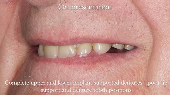 Newsletter 57 showcases the making and fitting process of implant-supported complete dentures for Alisdair