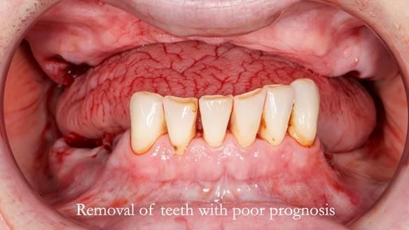 Newsletter 52 Managing Jo’s failing dentition with extractions and Mk 1/Mk 2 complete upper dentures and lower partial dentures FULL PROTOCOL