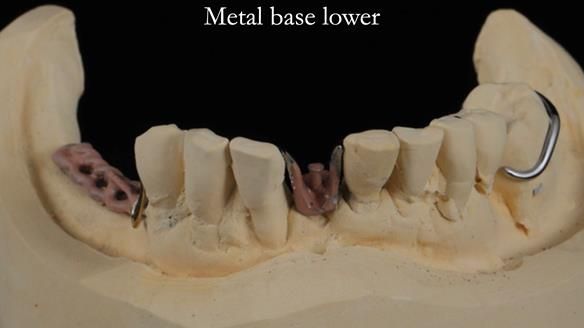 Newsletter 54 case presentation upper complete denture and lower Scandinavian designed hygienic partial denture for David