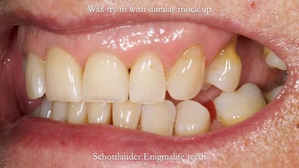 Finlay's Newsletter 61 provision of a lower unilateral free end saddle metal based partial denture for Joyce