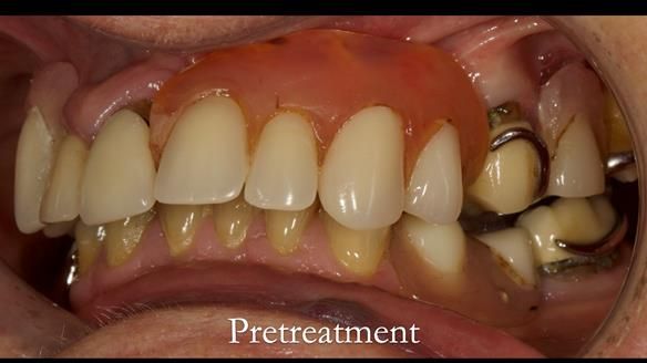 Eileen's transformation with upper and lower RPDs of Scandinavian hygienic design FULL PROTOCOL