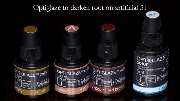 Newsletter 55 Provision of metal based partial dentures for Zephyrine with a repaired cleft lip and palate