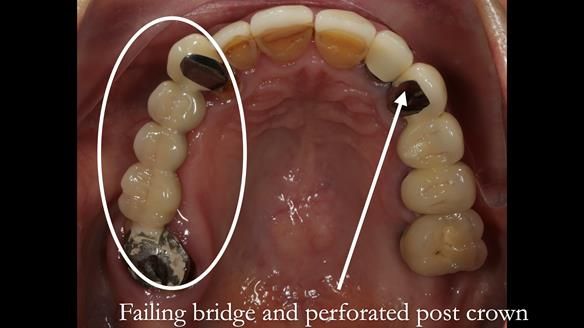 Newsletter 51 Managing Anne’s failing dentition with distal extension base RPD/Splint FULL PROTOCOL