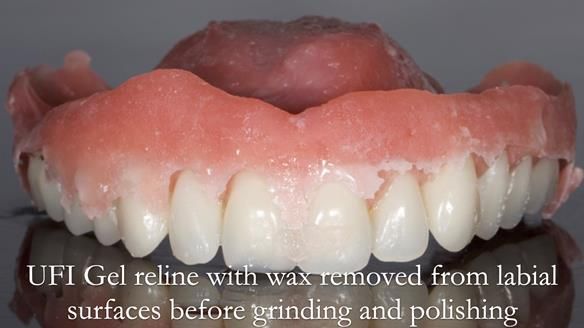 Newsletter 52 Managing Jo’s failing dentition with extractions and Mk 1/Mk 2 complete upper dentures and lower partial dentures FULL PROTOCOL