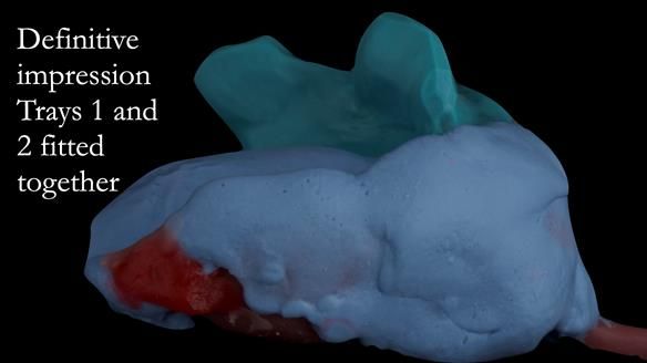 Upper metal base partial denture/occlusal stabilisation splint/obturator - full protocol