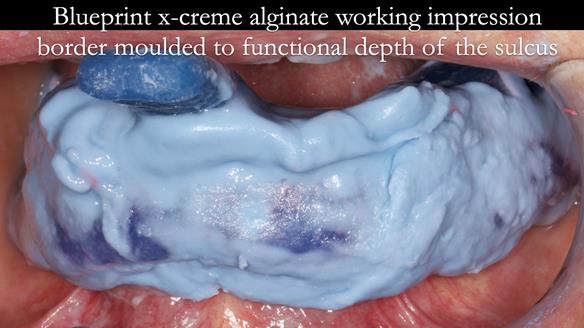 Finlay's Newsletter 61 provision of a lower unilateral free end saddle metal based partial denture for Joyce