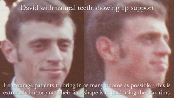 Newsletter 54 case presentation upper complete denture and lower Scandinavian designed hygienic partial denture for David