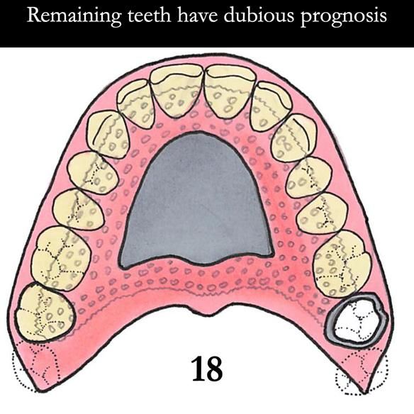 Universal Scandinavian partial denture designs